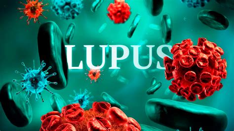 Investigadores Descubren Las Células Precursoras Del Lupus Eritematoso