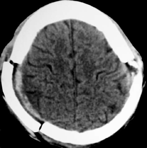 A Rare Case Of Spontaneous Bilateral Extradural Hematoma In A Sickle