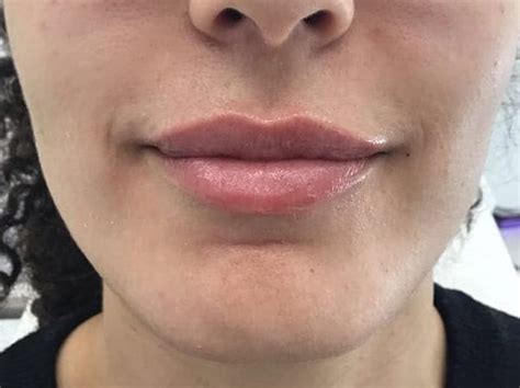 Lips Dr Tatiana Lapa Harley St Aesthetic Specialists