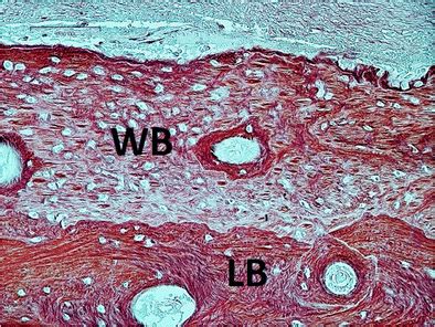 Newly Formed Woven Bone WB Containing Osteocytes In Lacuna On The