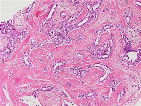 Figure 2 From A Radial Sclerosing Lesion Mimicking Breast Cancer On