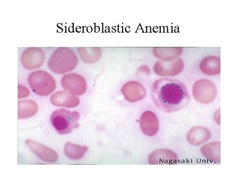 Anemia Sideroblástica Causas Sintomas Diagnóstico Tratamento Um