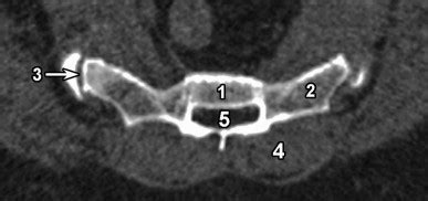 Sacral Anatomy | Radiology Key
