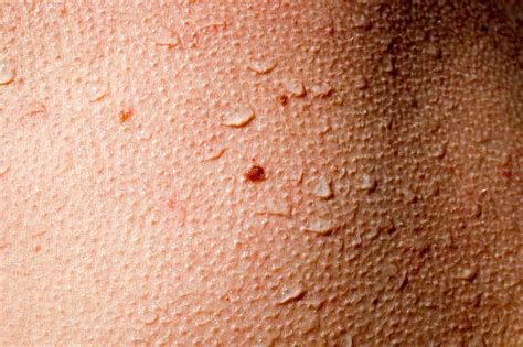 Goosebumps Close Up Stock Photos Pictures And Royalty Free Images Istock