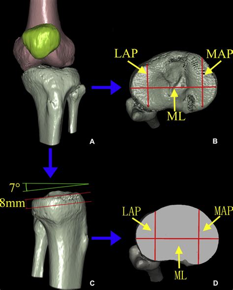 Morphometry Of The Tibial Plateau At The Surface And Resected Levels