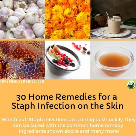 How To Treat Staph Infection At Home Treat Mania