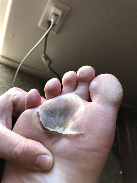 One Week After A Hot Pavement Foot Race Blisterits Clean The Dead