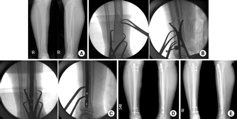 Figure 2 From Intramedullary Nailing Of Distal Tibial Fractures With