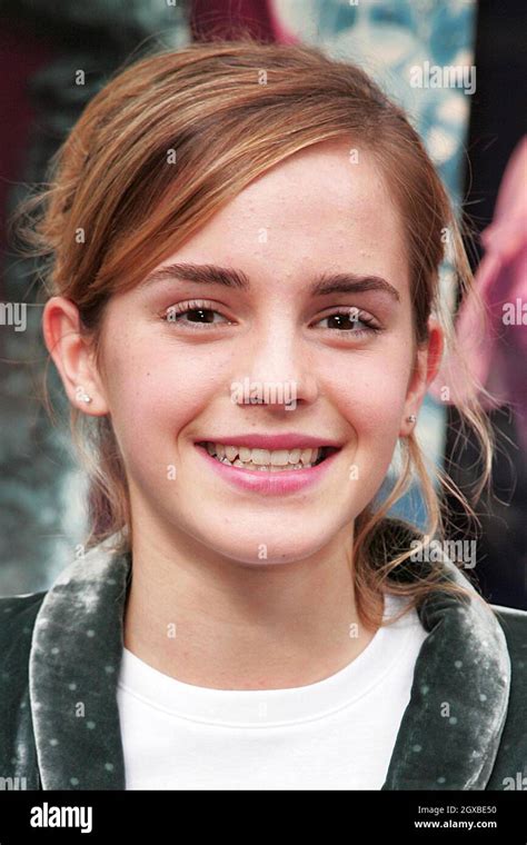Emma Watson Before And After Braces