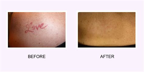 Laser Tattoo Removal What You Need To Know To Get Started