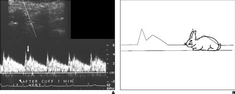 Figure 7 From A Spectrum Of Doppler Waveforms In The Carotid And