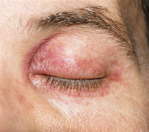 Learn About Eyelid Dermatitis Including Types Causes Symptoms And