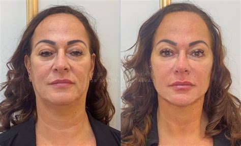 Bloco 2 programa 320 exibido em 14 de setembro de 2019 na rede ngt, com entrevista do farmacêutico esteta, dr. Mãe de Neymar, Nadine investe em harmonização facial ...