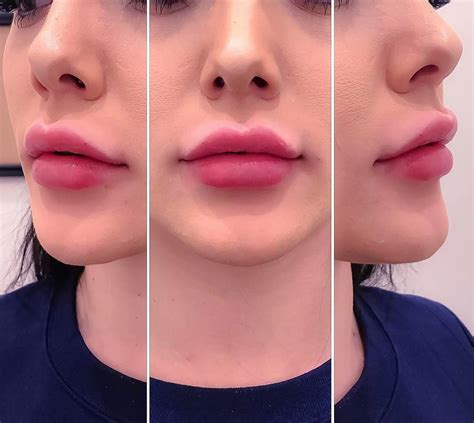 Какие виды губ можно сделать филлерами фото