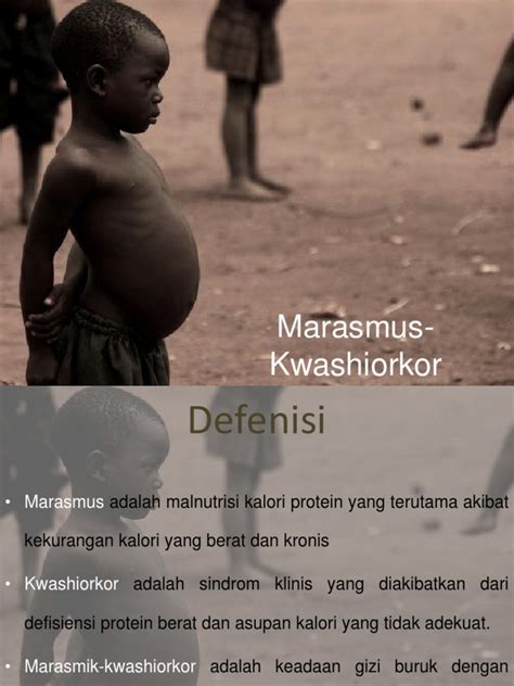 Marasmus Kwashiorkor