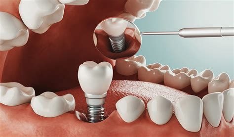 How Dental Implants Works Veneers Oficial
