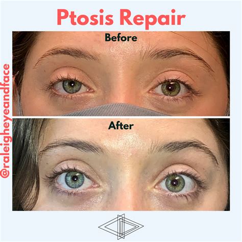 Ptosis Repair Raleigh Eye And Face Plastic Surgery