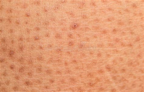 Skin Problemdry Skin Ichthyosis Vulgaris Stock Image Image Of