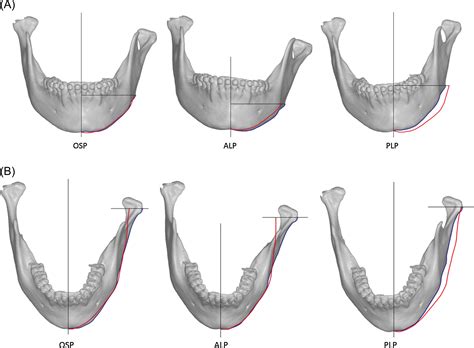Evaluation Of Mandibular Contour In Patients With Significant Facial