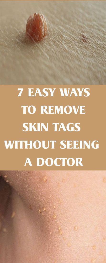 home remedies for skin tags skin tag removal home remedies for skin skin tag