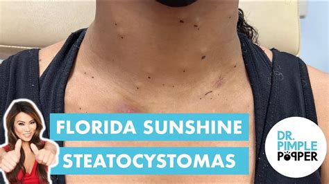 Florida Sunshine Steatocystomas Recently Added Dr Pimple Popper