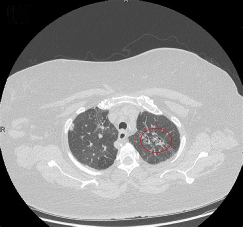 Cureus Sarcoidosis Presenting In Breast Imaging Clinic With