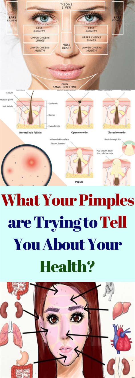 See What Your Pımples Are Trying To Tell You About Your Health