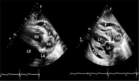 D Subcostal View Of The Heart From A Patient With Cardiac Tamponade