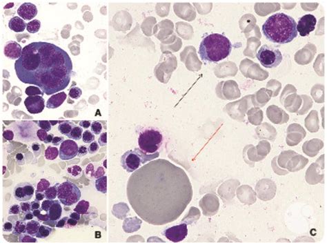 Extreme Dyserythropoiesis In The Setting Of Acute Erythroid Leukemia