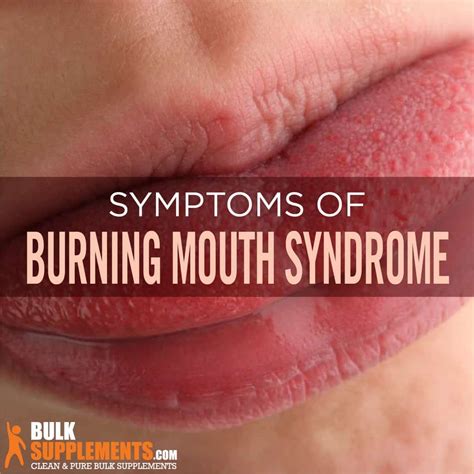 Burning Mouth Syndrome Bms Symptoms Causes And Treatment