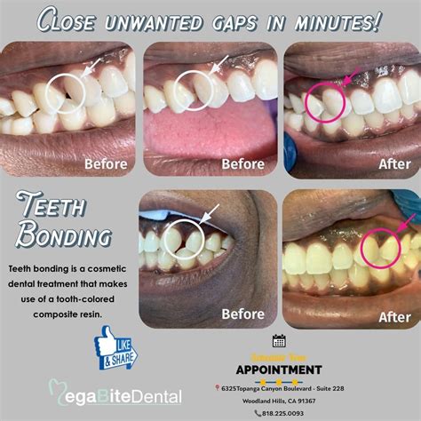 They work by gradually applying pressure to your teeth to close the gap over time. Close unwanted gaps in minutes! ⠀ Dental bonding, or ...