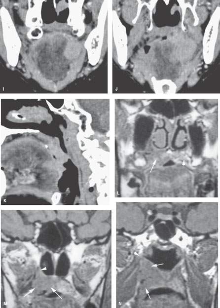 Oropharynx Malignant Tumors Radiology Key