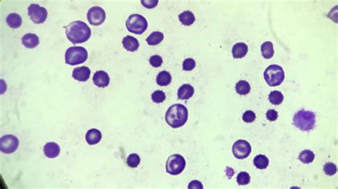 Anaemic Changes Anisocytosis Microcytosis Youtube