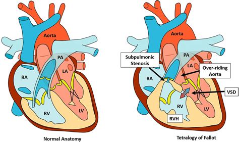 The Lesions Of Tetralogy Of Fallot Right Panel Compared To Normal