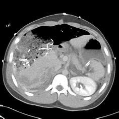 See full list on radiopaedia.org 86 Hepatobiliary Radiology ideas | radiology, radiography ...