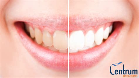 What Does It Mean To Have Translucent Teeth