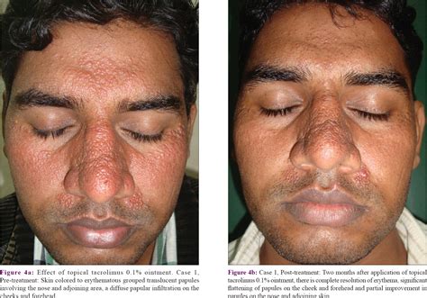 Lichenoid Pseudovesicular Papular Eruption On Nose A Papular Facial Dermatosis Probably Related
