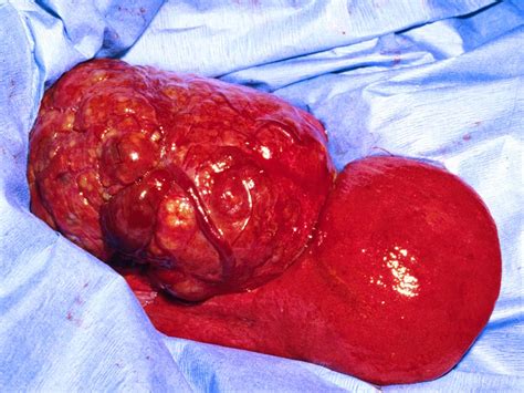 Ongoing weight loss, vomiting, loss of appetite and pale gums develop as the tumor becomes larger. Veterinary Key Points: Message to Massive Liver Tumors in ...