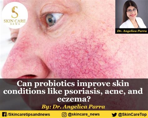 Can Probiotics Improve Skin Conditions Like Psoriasis Acne And Eczema