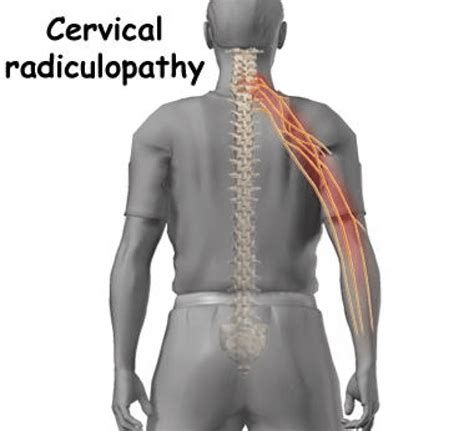 Finding Relief Cervical Radiculopathy And Chiropractic Care Pittsburgh Physical Medicine And