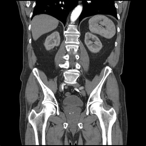 Coronal Abdomen Ct Labeled