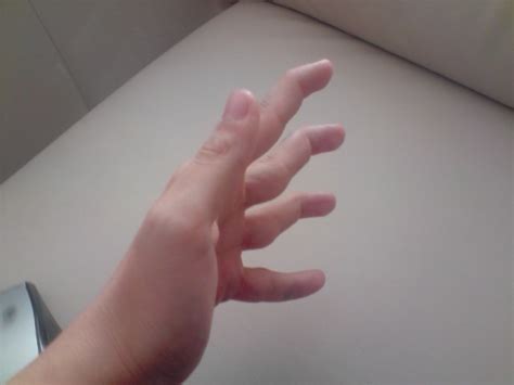 Als sofortmaßnahme ist das kühlen mit eisbeuteln oder kühlakkus empfehlenswert. Ich kann meine Fingerspitzen krümmen - Ist das normal?