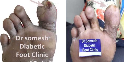 Diabetic Foot Gangrene Stages Great Toe Tip Podiatry Doctor