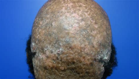 Dissecting Cellulitis Osei Tutu Dermatology And Hair Restoration