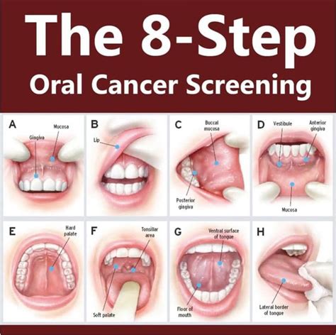 April Is Oral Cancer Awareness Month Morrisburg Dental Dentist In Morrisburg Ontario