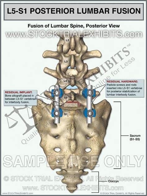 Trial Exhibit Which Depicts Lumbar Spine Interbody Fusion Shown From