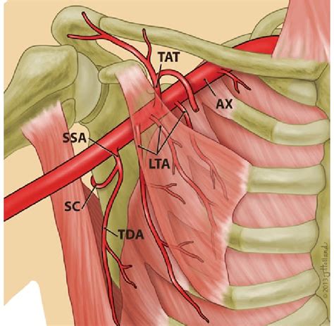 Type V Multiple Lateral Thoracic Arteries Lta Are Present 32