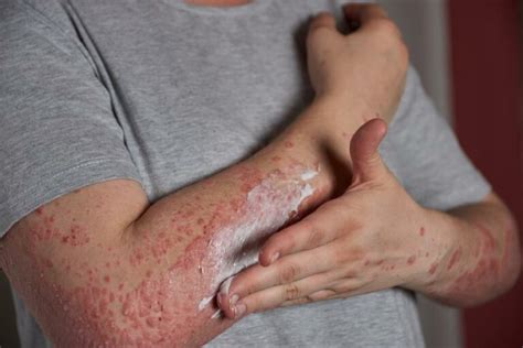 Dermatite atópica o que é e como tratar