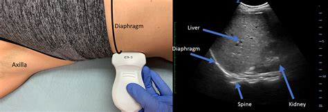 Ultrasound Diaphragm Position And View Aliem