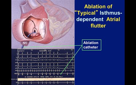 Atrial Flutter — 15 Facts You May Want To Know